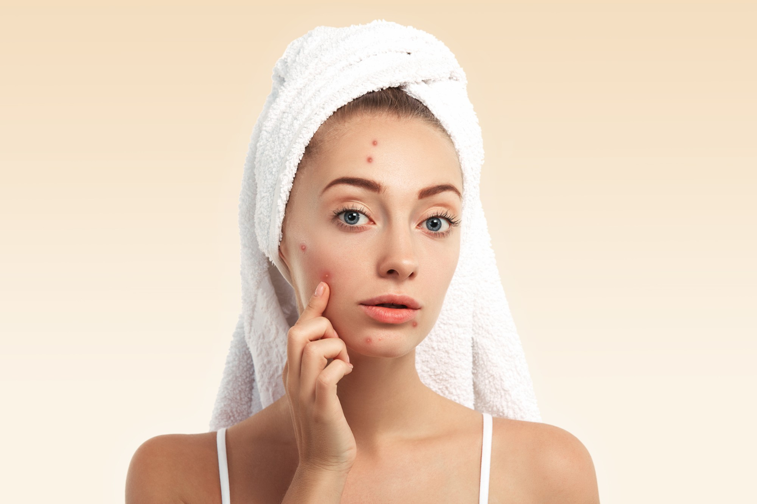 HydraFacial for Acne